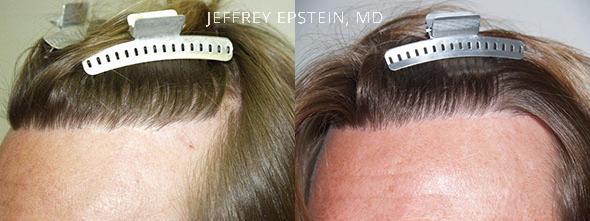 Reparative Before and after in Miami, FL, Paciente 40483