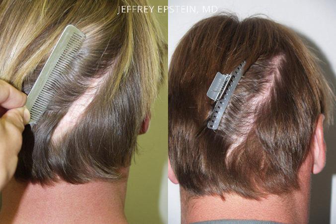 Reparative Hair Transplant Before and after in Miami, FL, Paciente 40483