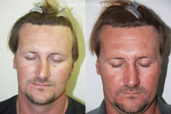 Reparative Hair Transplant Before and after in Miami, FL, Paciente 40483