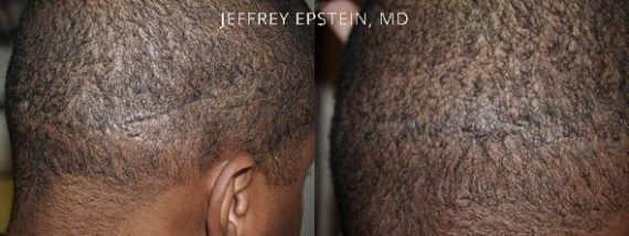 Reparative Hair Transplant Before and after in Miami, FL, Paciente 40492