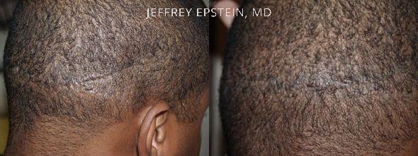 Reparative Before and after in Miami, FL, Paciente 40492