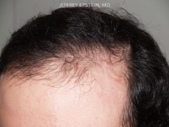 Reparative Hair Transplant Before and after in Miami, FL, Paciente 40498