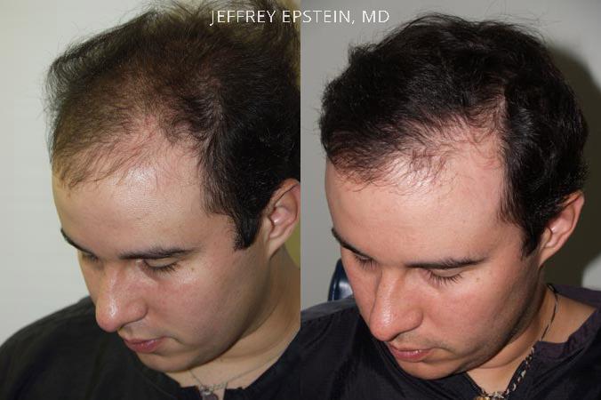 Reparative Hair Transplant Before and after in Miami, FL, Paciente 40498