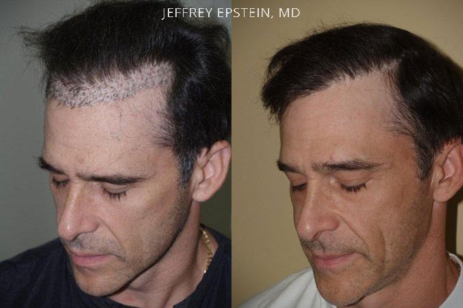 Reparative Before and after in Miami, FL, Paciente 40502