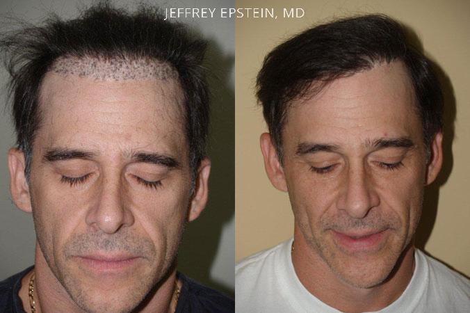 Reparative Hair Transplant Before and after in Miami, FL, Paciente 40502