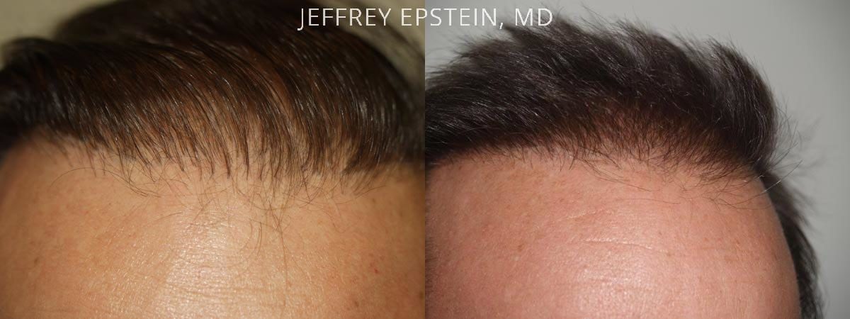 Reparative Hair Transplant Before and after in Miami, FL, Paciente 40510
