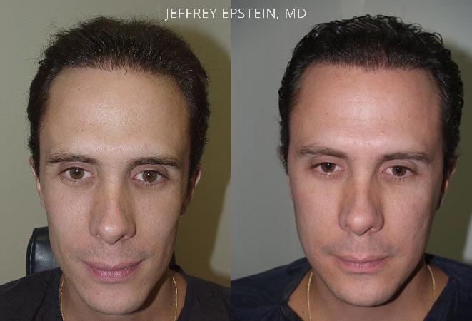 Reparative Before and after in Miami, FL, Paciente 40515