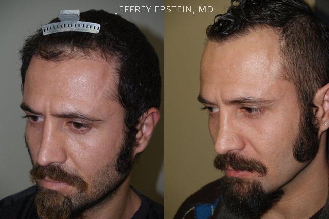 Reparative Hair Transplant Before and after in Miami, FL, Paciente 40518