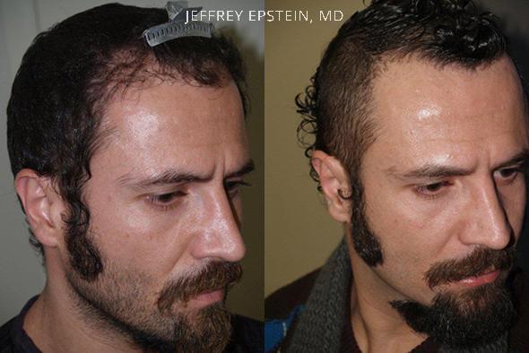 Reparative Before and after in Miami, FL, Paciente 40518