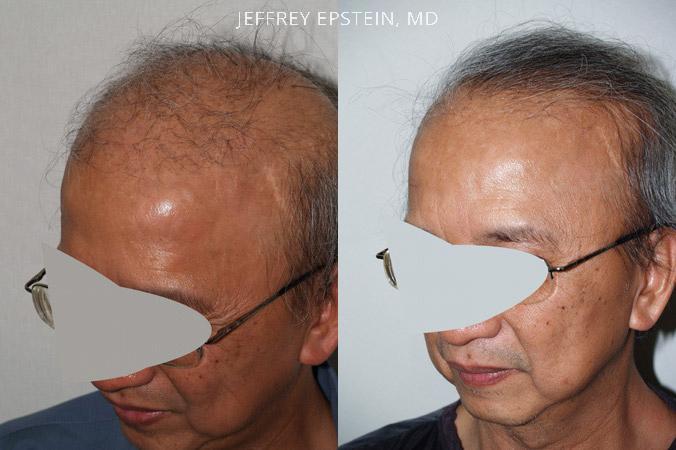 Reparative Before and after in Miami, FL, Paciente 40528