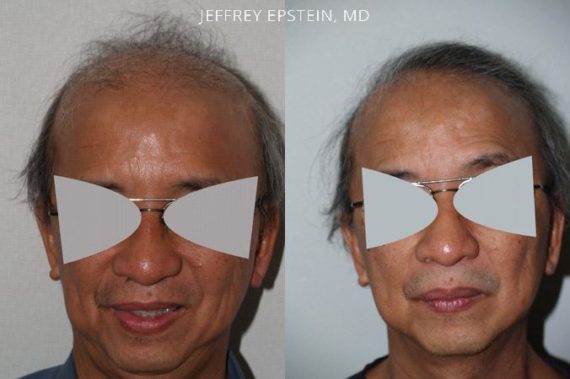 Reparative Hair Transplant Before and after in Miami, FL, Paciente 40528
