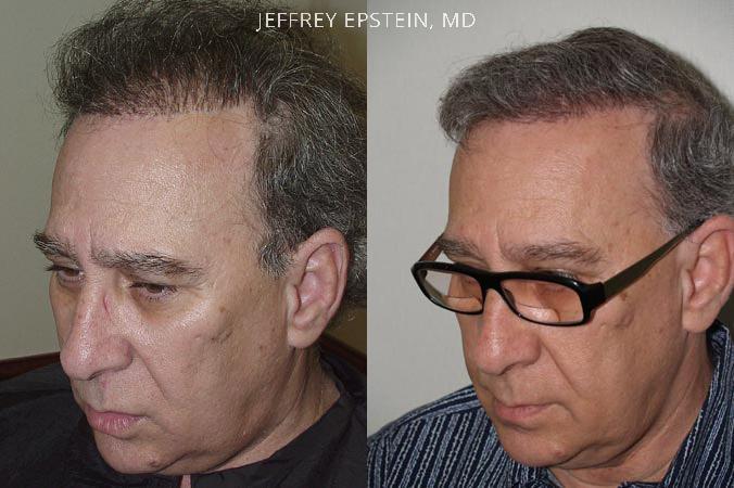 Reparative Hair Transplant Before and after in Miami, FL, Paciente 40535