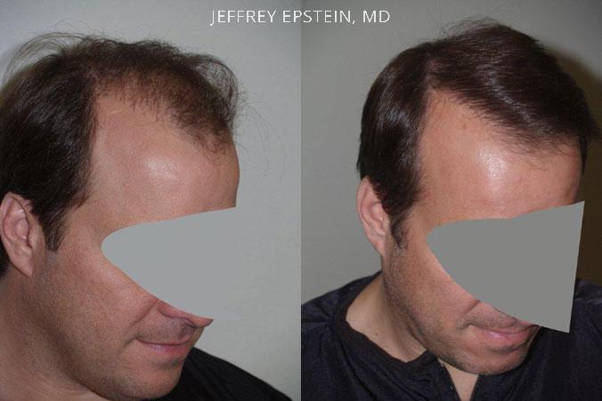 Reparative Hair Transplant Before and after in Miami, FL, Paciente 40549
