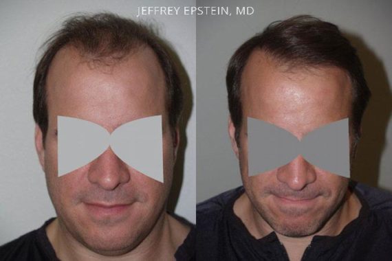 Reparative Hair Transplant Before and after in Miami, FL, Paciente 40549