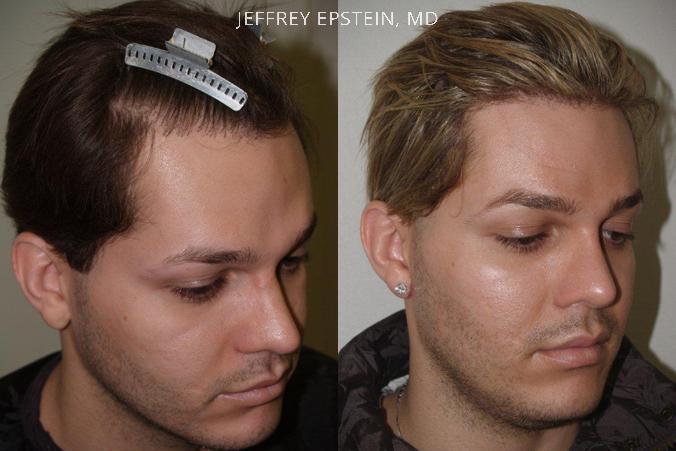 Reparative Hair Transplant Before and after in Miami, FL, Paciente 40557