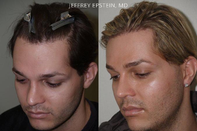 Reparative Before and after in Miami, FL, Paciente 40557