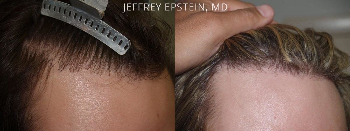 Reparative Hair Transplant Before and after in Miami, FL, Paciente 40557