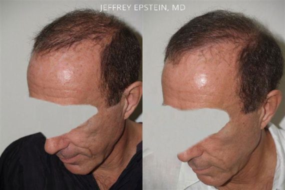 Reparative Hair Transplant Before and after in Miami, FL, Paciente 40568