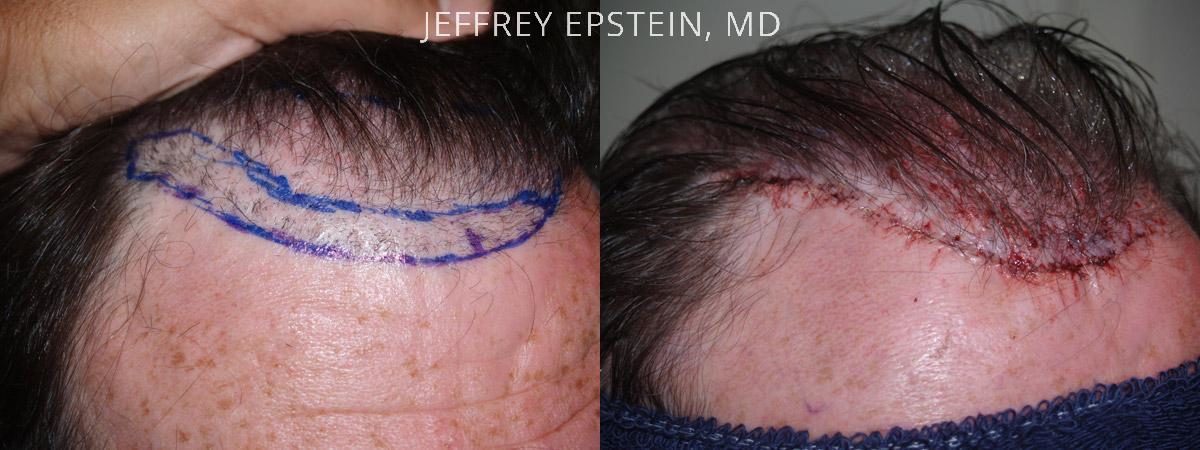 Reparative Hair Transplant Before and after in Miami, FL, Paciente 40571