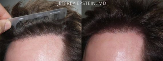 Reparative Hair Transplant Before and after in Miami, FL, Paciente 40574