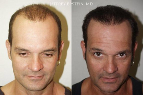 Reparative Hair Transplant Before and after in Miami, FL, Paciente 40577