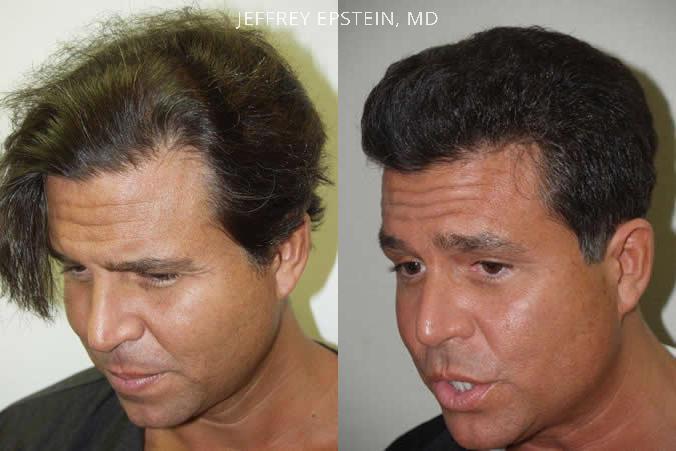 Reparative Hair Transplant Before and after in Miami, FL, Paciente 40582