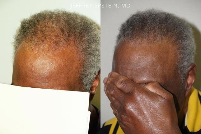 Reparative Hair Transplant Before and after in Miami, FL, Paciente 40585