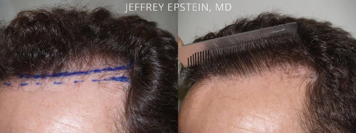 Reparative Hair Transplant Before and after in Miami, FL, Paciente 40588