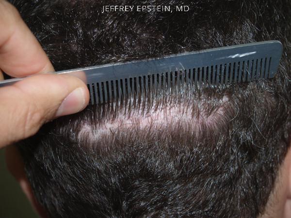 Reparative Hair Transplant Before and after in Miami, FL, Paciente 40588