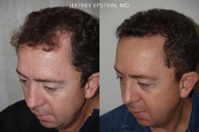 Reparative Before and after in Miami, FL, Paciente 40588