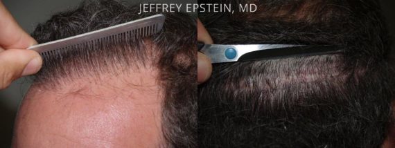 Reparative Hair Transplant Before and after in Miami, FL, Paciente 40597