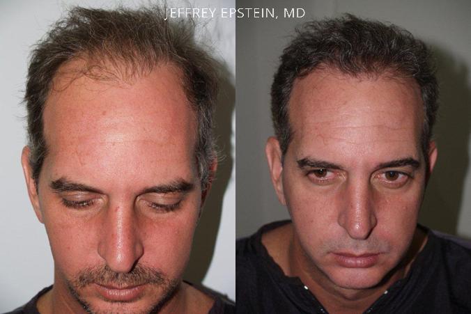 Reparative Before and after in Miami, FL, Paciente 40597