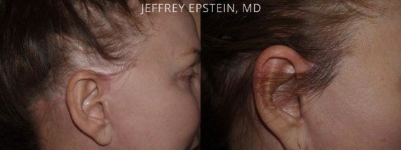 Reparative Hair Transplant Before and after in Miami, FL, Paciente 40603