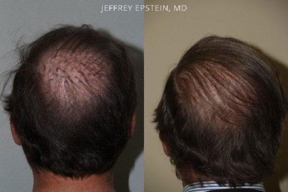 Reparative Hair Transplant Before and after in Miami, FL, Paciente 40606