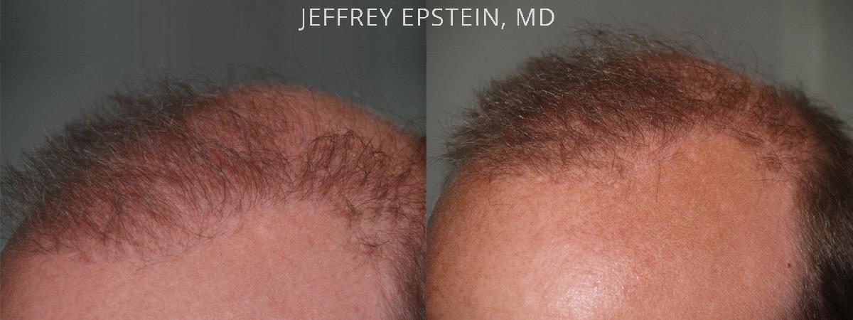 Reparative Hair Transplant Before and after in Miami, FL, Paciente 40615