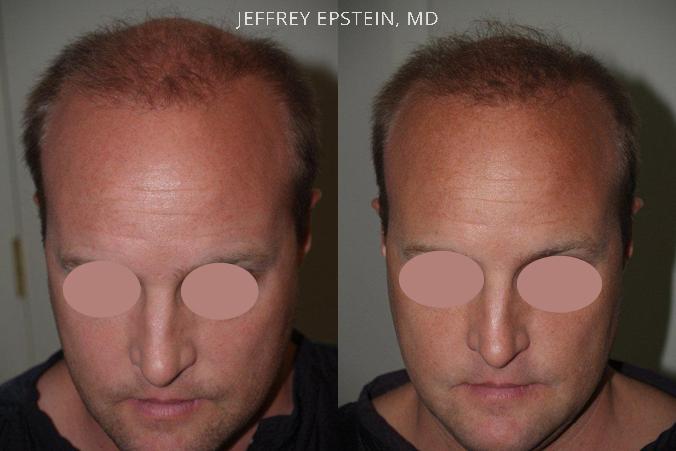Reparative Hair Transplant Before and after in Miami, FL, Paciente 40615