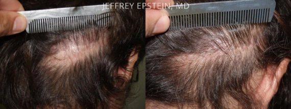 Reparative Hair Transplant Before and after in Miami, FL, Paciente 40624