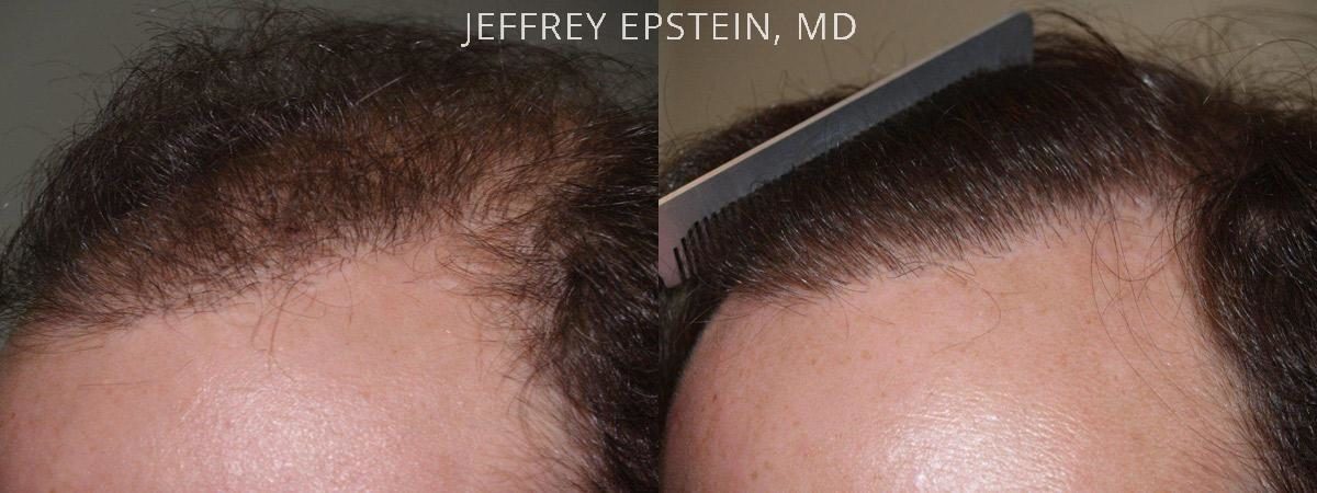 Reparative Hair Transplant Before and after in Miami, FL, Paciente 40638