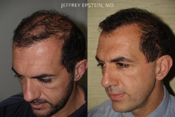 Reparative Hair Transplant Before and after in Miami, FL, Paciente 40643