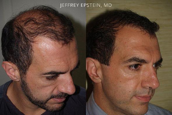 Reparative Hair Transplant Before and after in Miami, FL, Paciente 40643