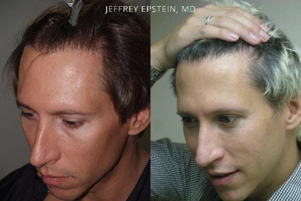 Reparative Hair Transplant Before and after in Miami, FL, Paciente 40648