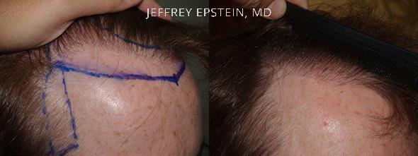 Reparative Hair Transplant Before and after in Miami, FL, Paciente 40656