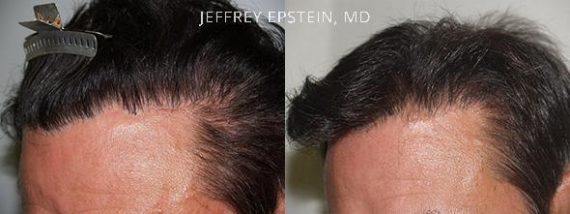 Reparative Hair Transplant Before and after in Miami, FL, Paciente 40666