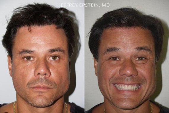 Reparative Hair Transplant Before and after in Miami, FL, Paciente 40666