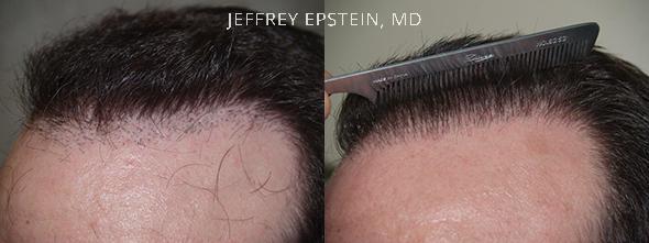 Reparative Hair Transplant Before and after in Miami, FL, Paciente 40674