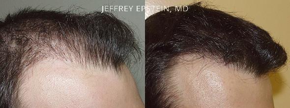 Reparative Hair Transplant Before and after in Miami, FL, Paciente 40678