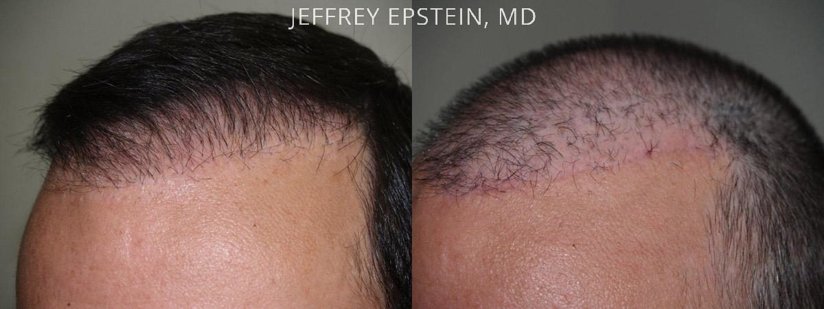 Reparative Before and after in Miami, FL, Paciente 40681