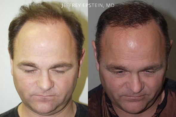Reparative Hair Transplant Before and after in Miami, FL, Paciente 40705