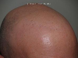Reparative Hair Transplant Before and after in Miami, FL, Paciente 40725