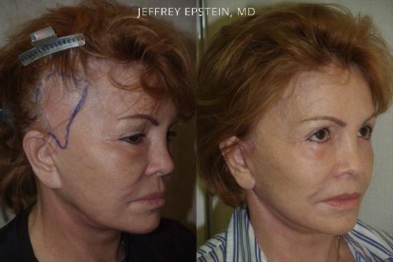 Reparative Hair Transplant Before and after in Miami, FL, Paciente 40741